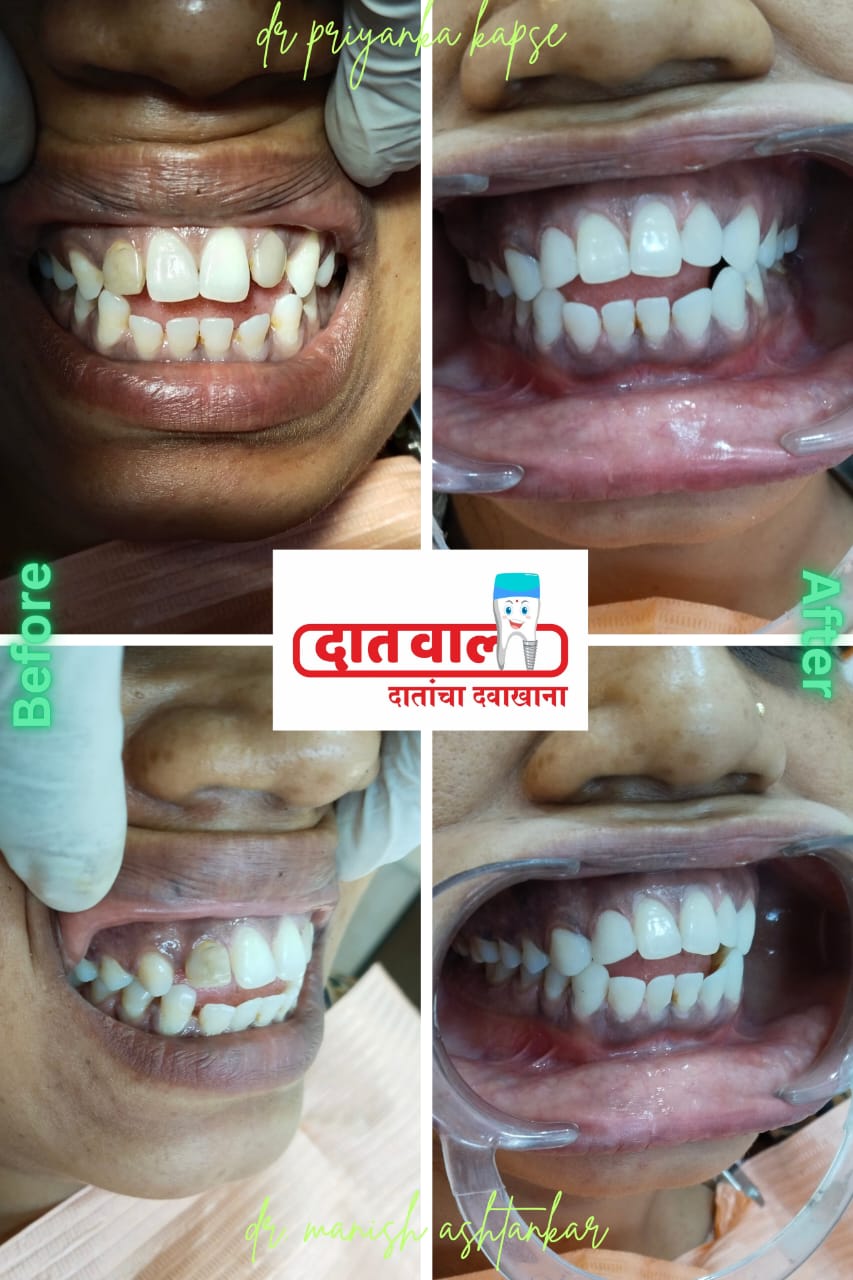 Dental Implants